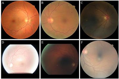 Retinal Image Enhancement Using Cycle-Constraint Adversarial Network